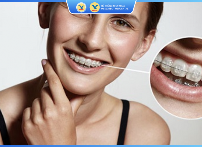 Niềng răng mắc cài pha lê